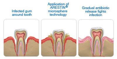 Antimicrobial Periodontal Therapy 