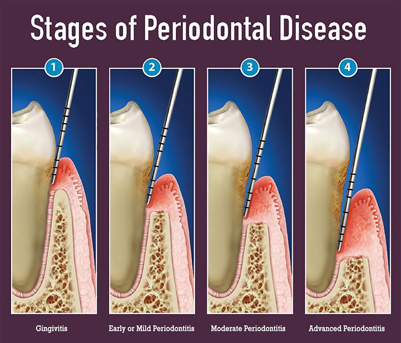 stages of periodontal disease